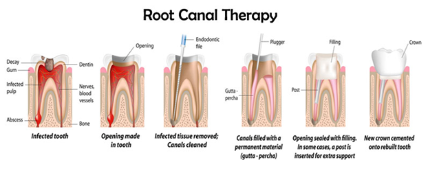 root canal treatment cost in pune