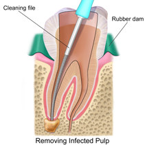 Root Canal Treatments in Pune
