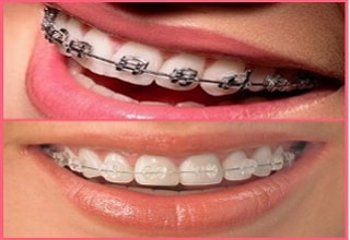 Teeth Braces treatment in Pune