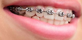 metal braces in pune with cost