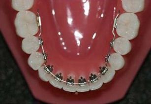 tooth braces in pune